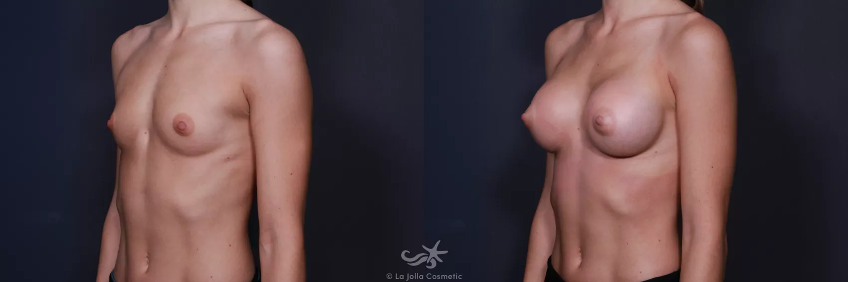 Before & After Breast Augmentation Result 195 Left Oblique View in San Diego, CA