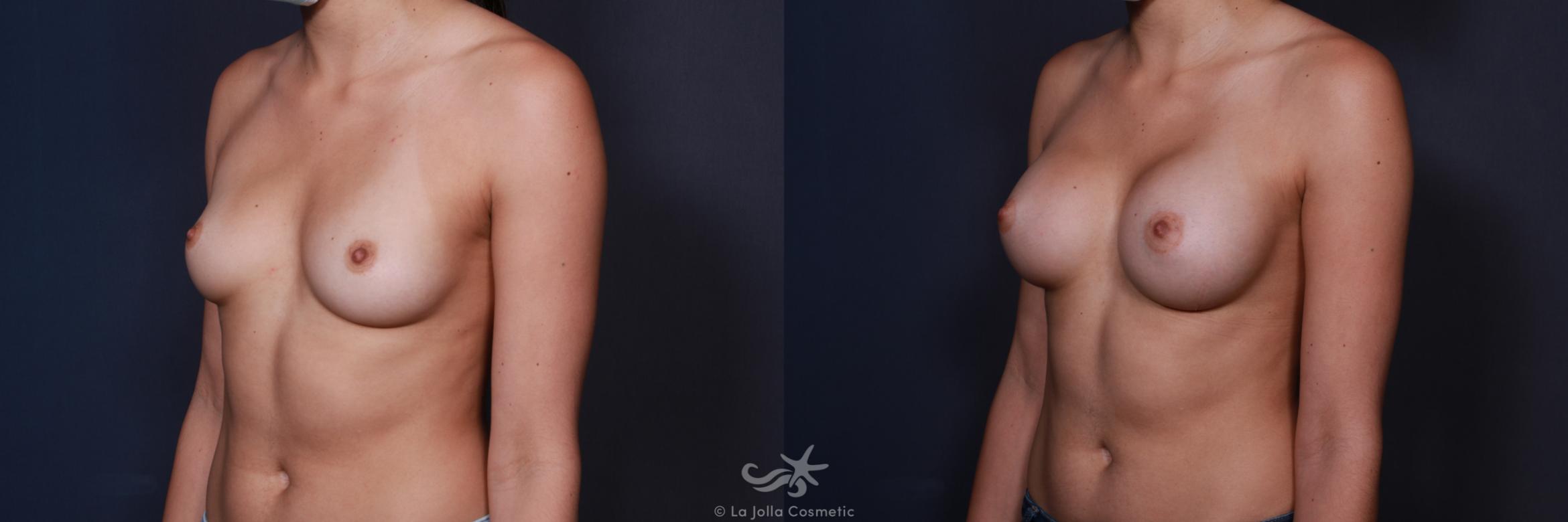 Before & After Breast Augmentation Result 196 Left Oblique View in San Diego, CA