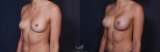 Before & After Breast Augmentation Result 196 Left Oblique View in San Diego, Carlsbad, CA