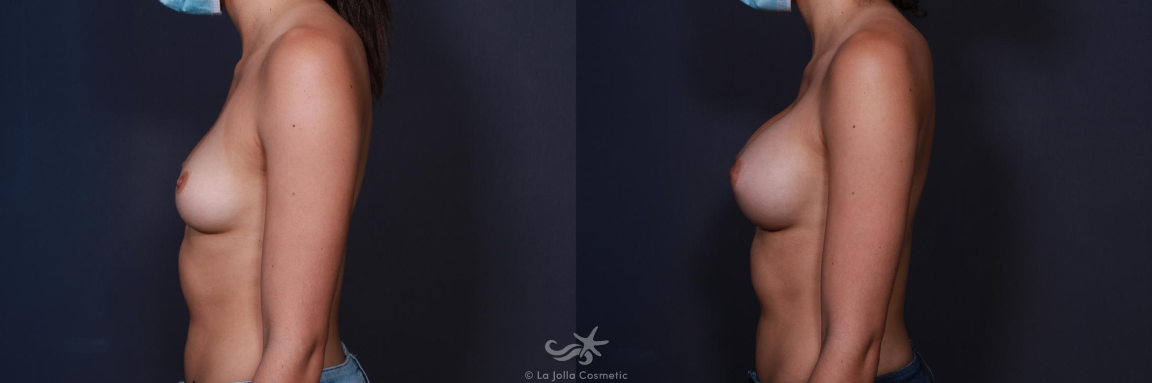 Before & After Breast Augmentation Result 196 Left Side View in San Diego, CA