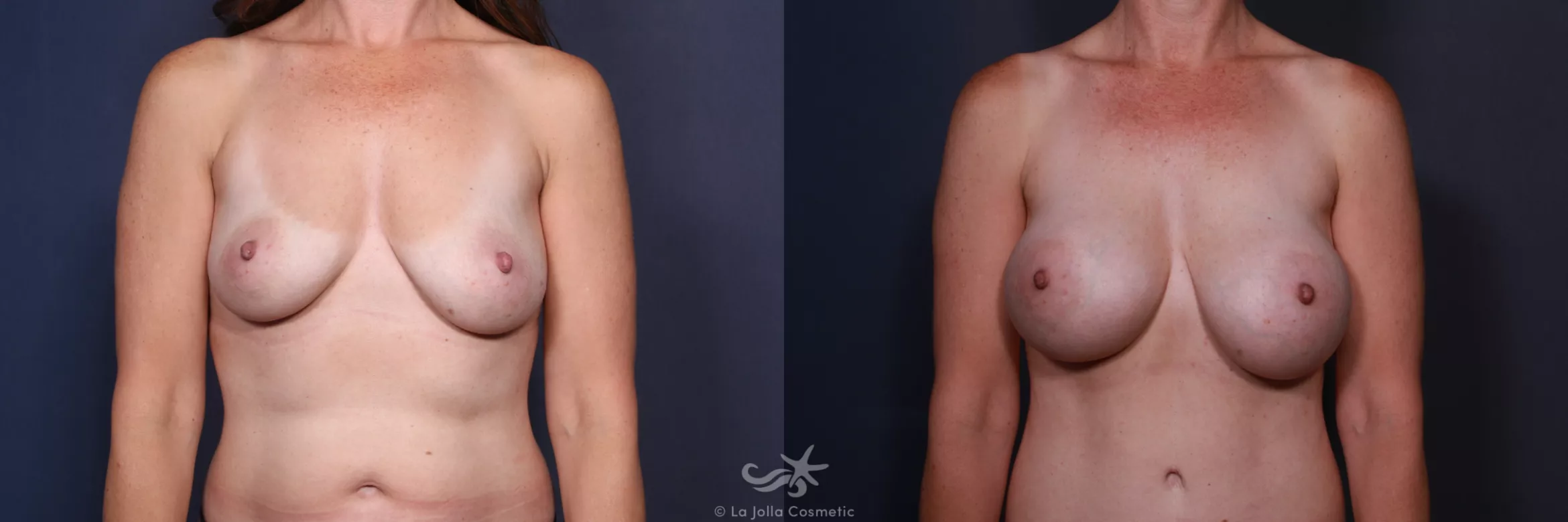 Before & After Breast Augmentation Result 198 Front View in San Diego, CA