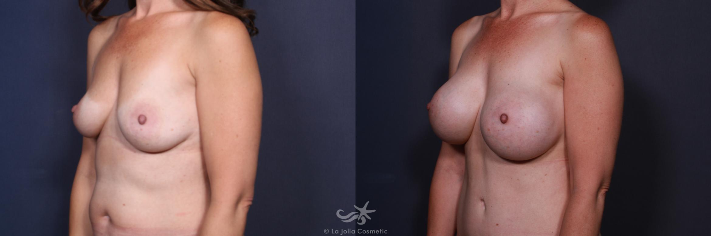 Before & After Breast Augmentation Result 198 Left Oblique View in San Diego, CA