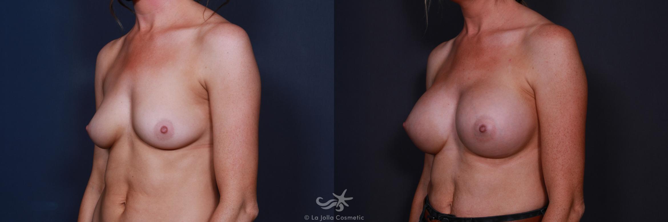 Before & After Breast Augmentation Result 199 Left Oblique View in San Diego, CA
