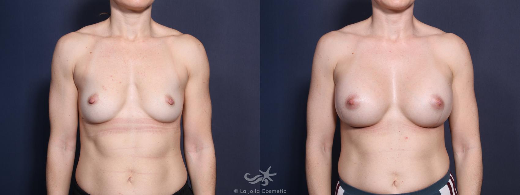 Before & After Breast Augmentation Result 20 Front View in San Diego, CA