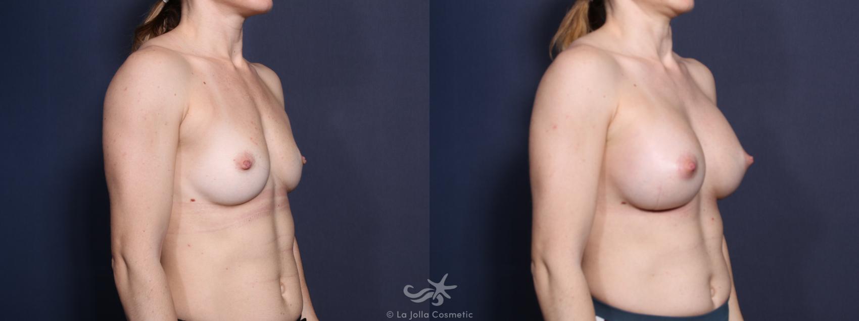 Before & After Breast Augmentation Result 20 Right Oblique View in San Diego, CA
