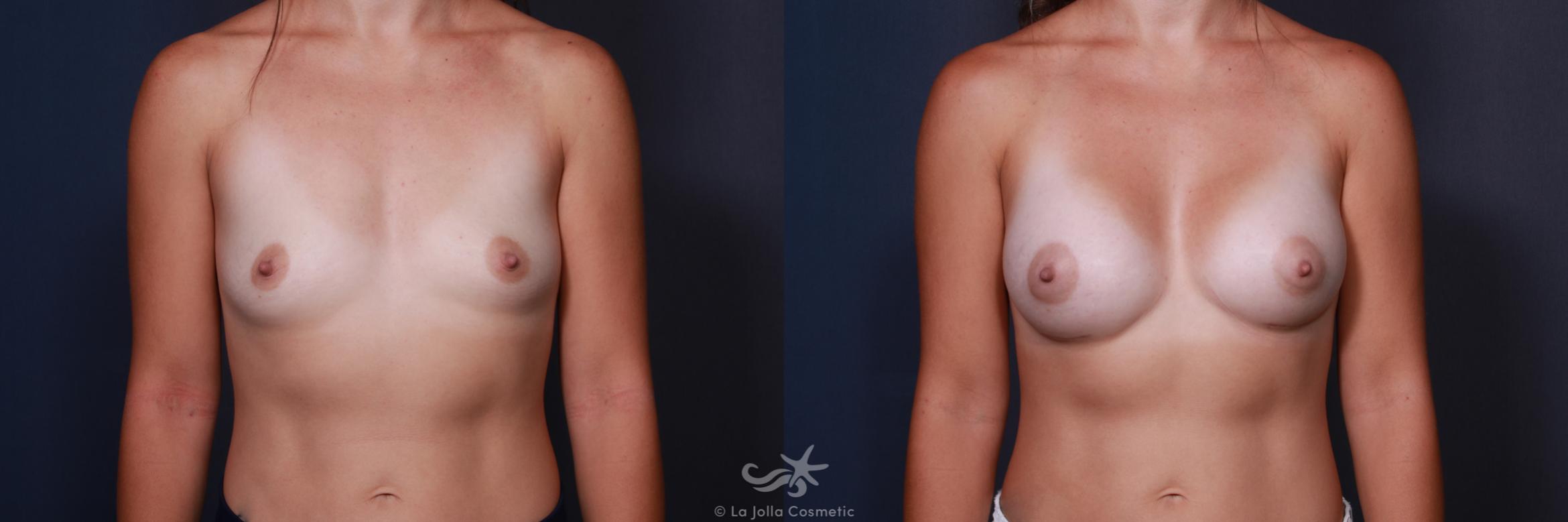 Before & After Breast Augmentation Result 201 Front View in San Diego, CA