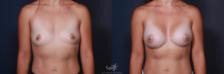Before & After Breast Augmentation Result 201 Front View in San Diego, Carlsbad, CA