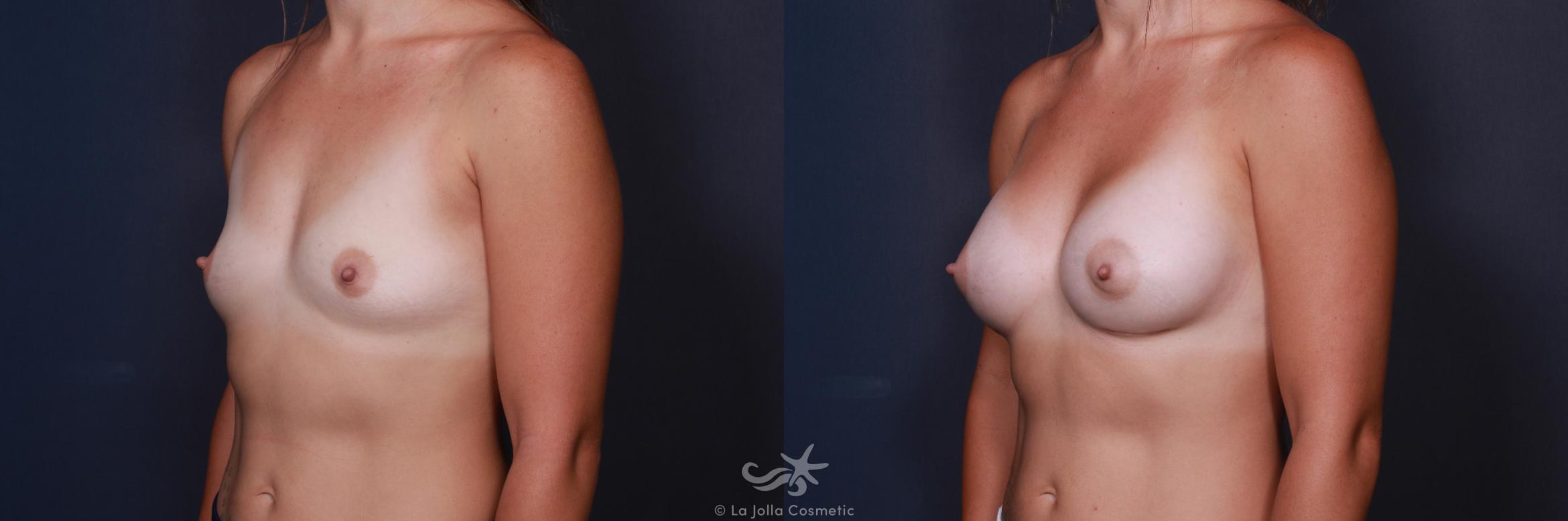 Before & After Breast Augmentation Result 201 Left Oblique View in San Diego, CA