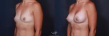 Before & After Breast Augmentation Result 201 Left Oblique View in San Diego, Carlsbad, CA