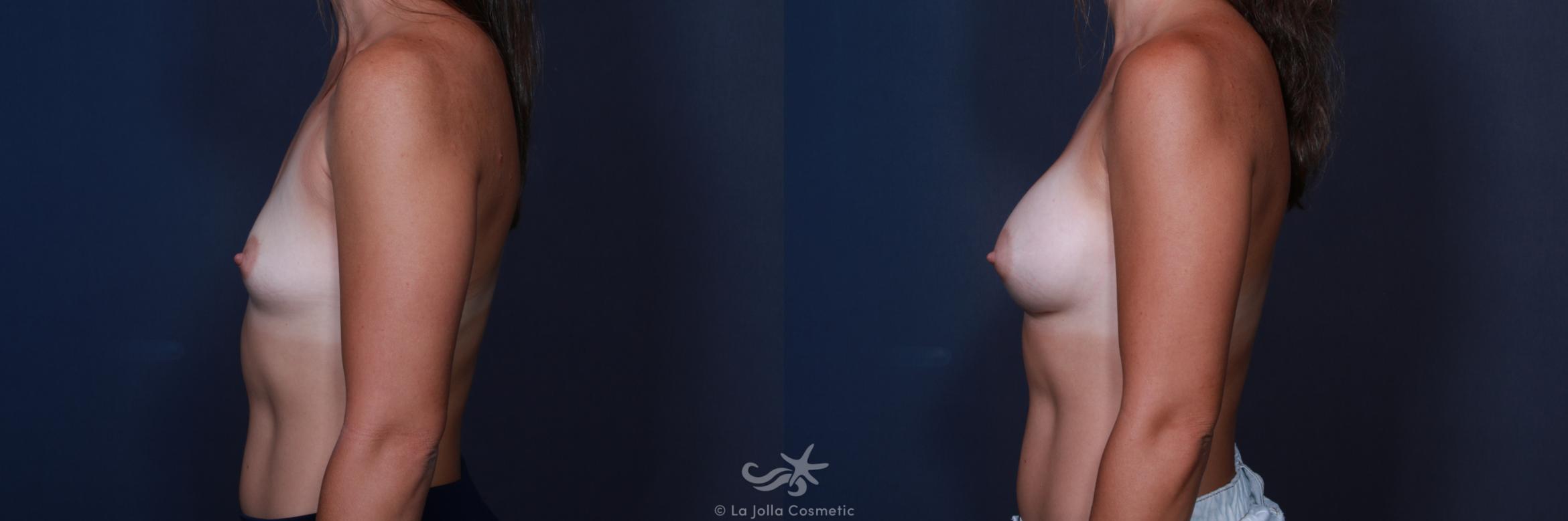 Before & After Breast Augmentation Result 201 Left Side View in San Diego, CA