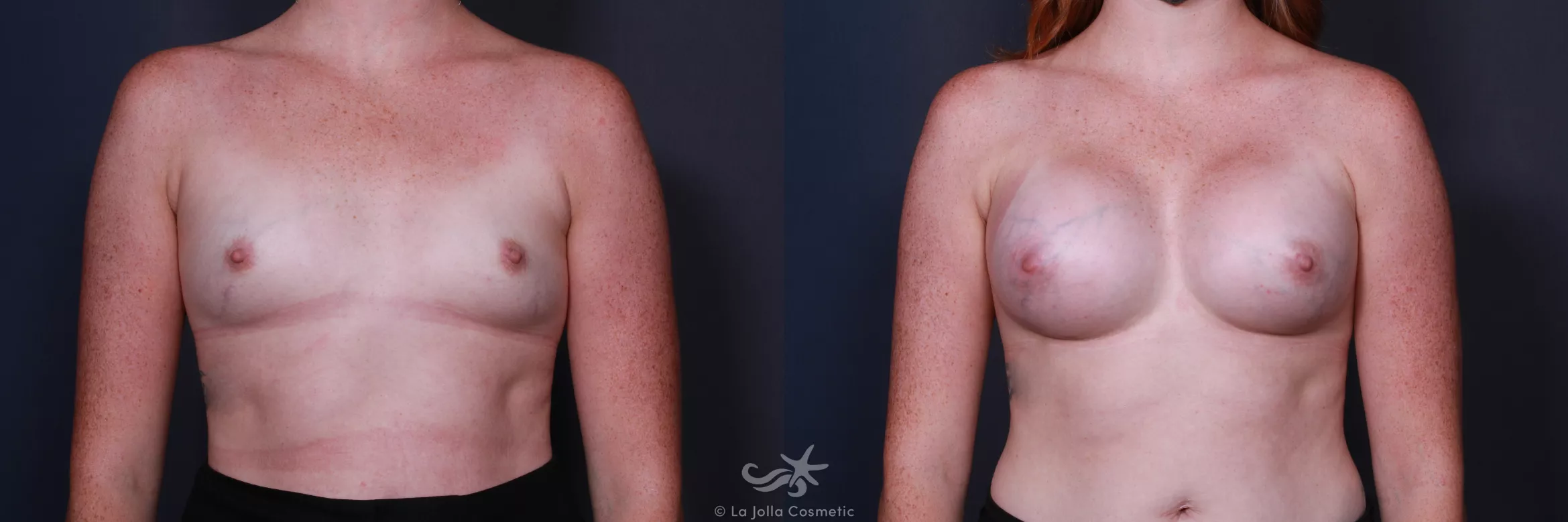Before & After Breast Augmentation Result 208 Front View in San Diego, CA