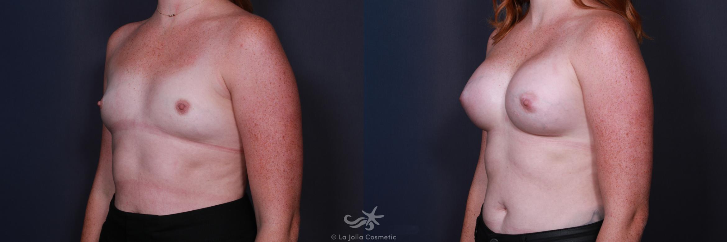 Before & After Breast Augmentation Result 208 Left Oblique View in San Diego, CA