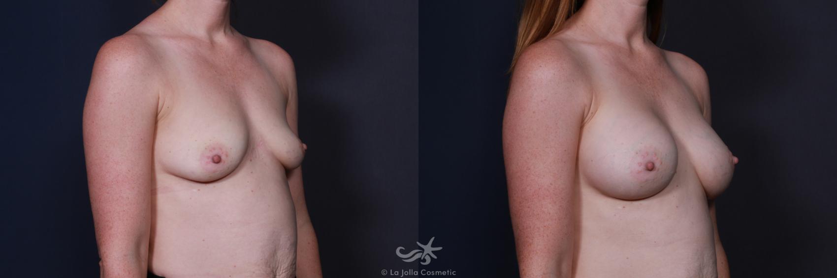 Before & After Breast Augmentation Result 209 Right Oblique View in San Diego, CA