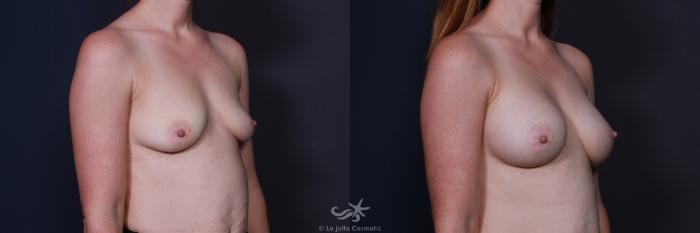 Before & After Breast Augmentation Result 209 Right Oblique View in San Diego, Carlsbad, CA