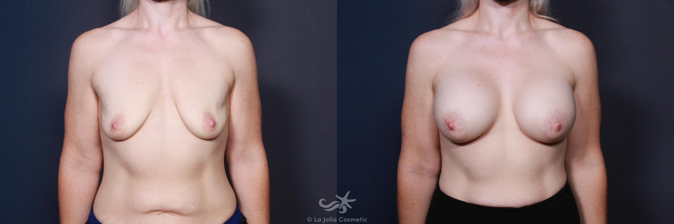 Before & After Breast Augmentation Result 21 Front View in San Diego, CA
