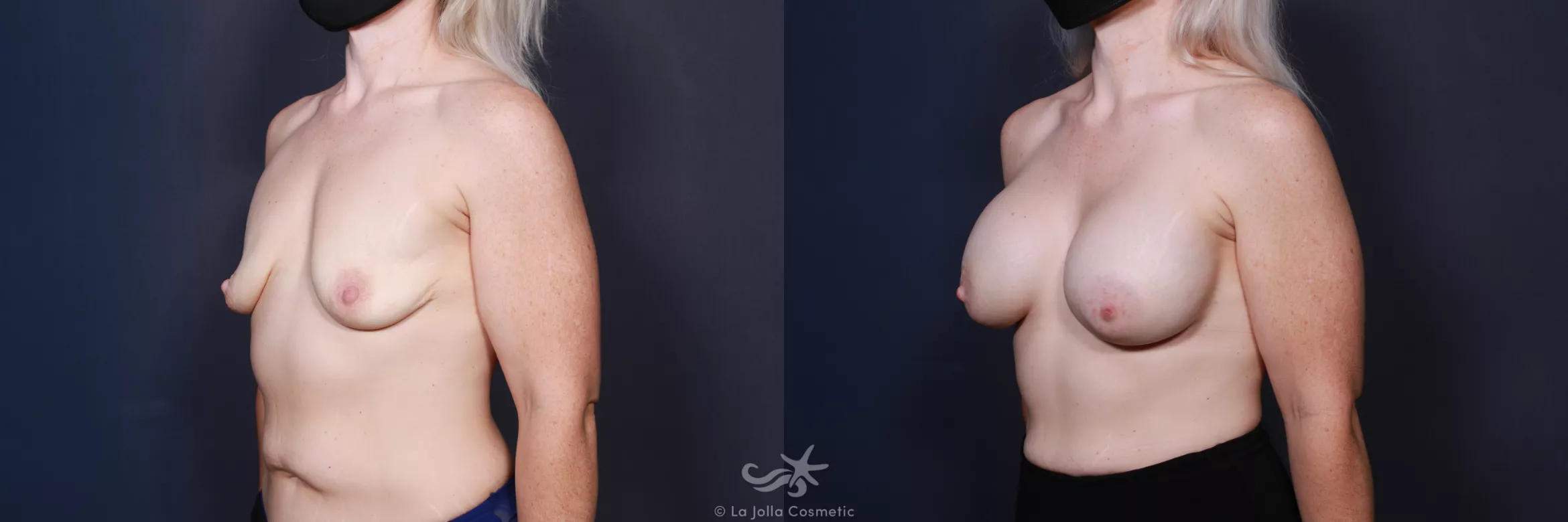 Before & After Breast Augmentation Result 21 Left Oblique View in San Diego, CA