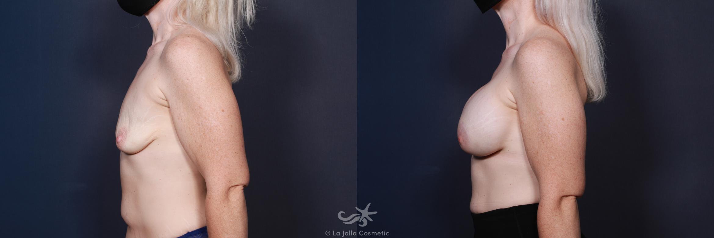 Before & After Breast Augmentation Result 21 Left Side View in San Diego, CA