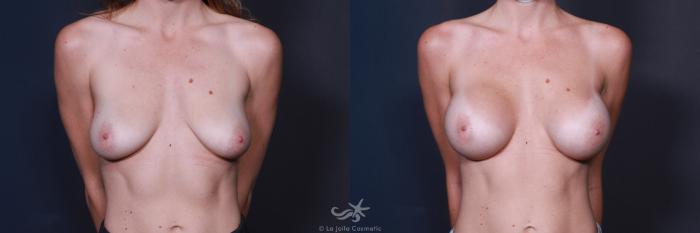 Before & After Breast Augmentation Result 215 Front View in San Diego, Carlsbad, CA