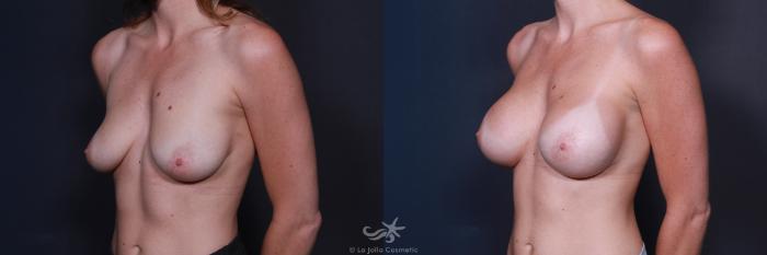 Before & After Breast Augmentation Result 215 Left Oblique View in San Diego, Carlsbad, CA