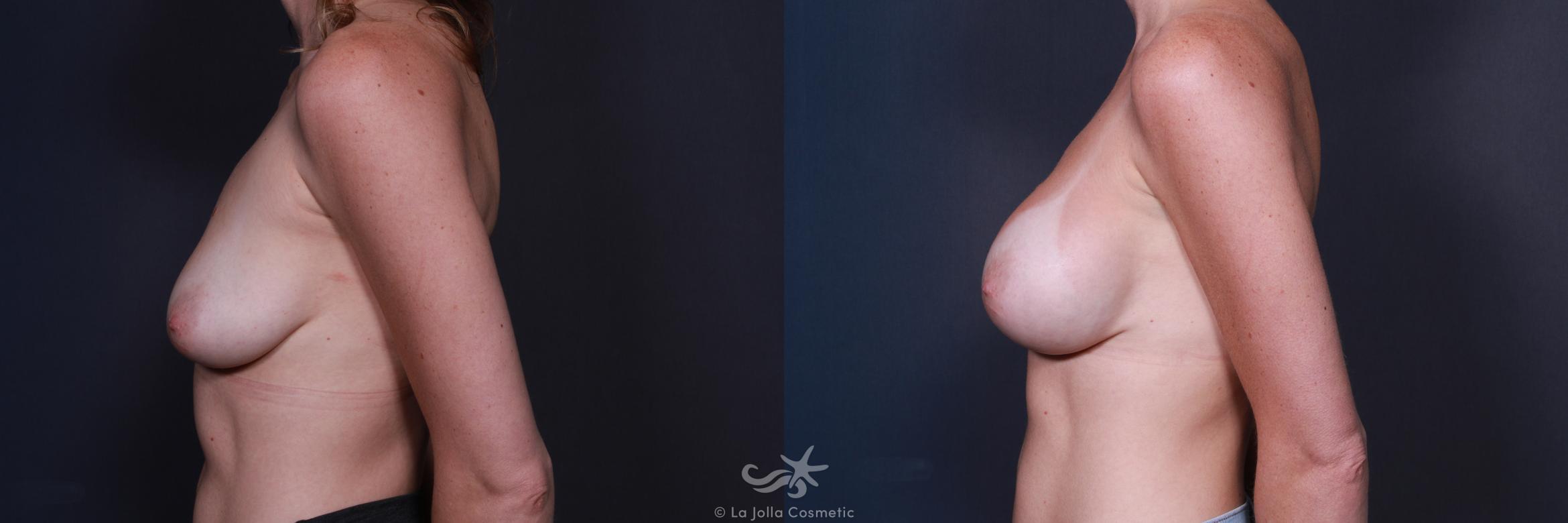 Before & After Breast Augmentation Result 215 Left Side View in San Diego, CA