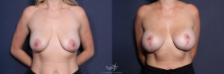 Before & After Breast Augmentation Result 222 Front View in San Diego, Carlsbad, CA