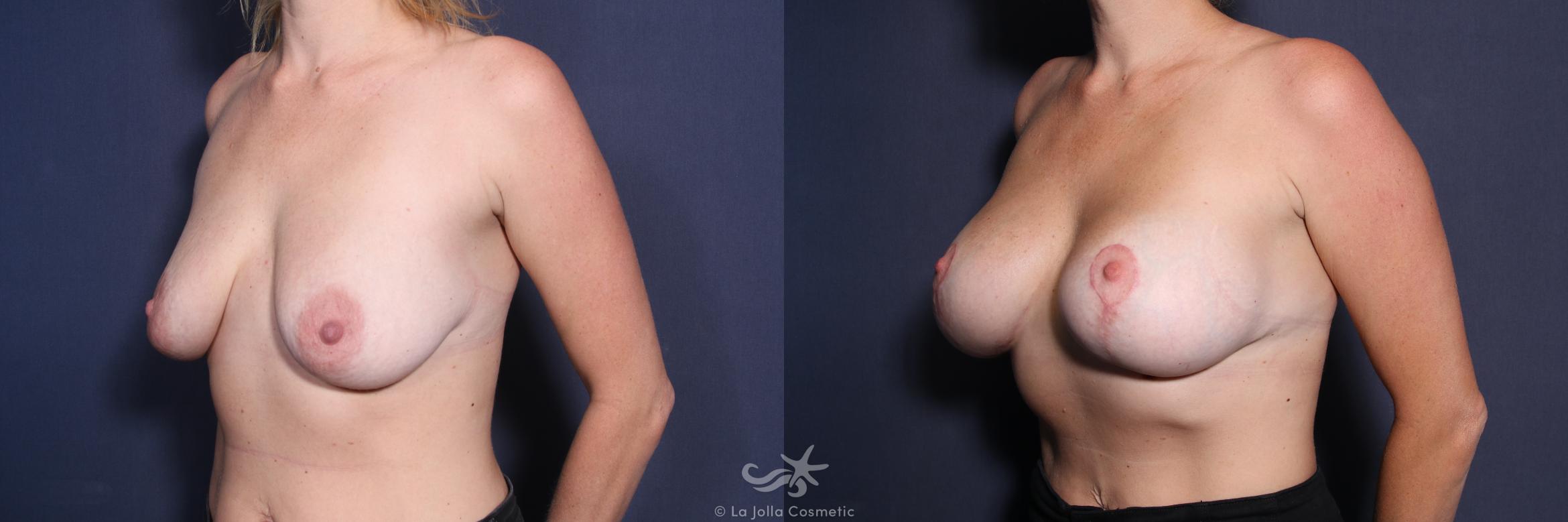 Before & After Breast Augmentation Result 222 Left Oblique View in San Diego, CA