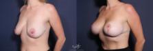 Before & After Breast Augmentation Result 222 Left Oblique View in San Diego, Carlsbad, CA