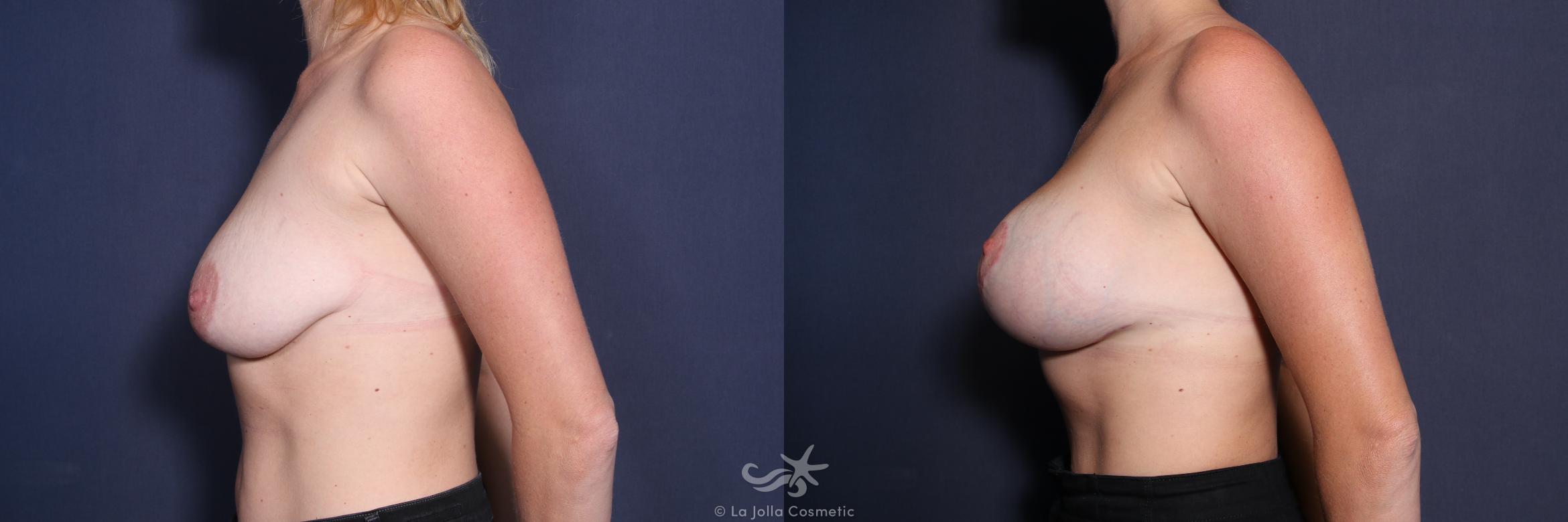 Before & After Breast Augmentation Result 222 Left Side View in San Diego, CA