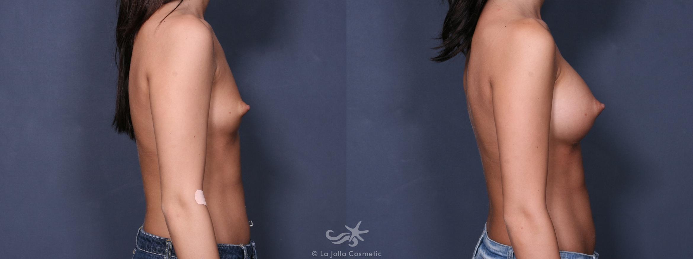 Before & After Breast Augmentation Result 224 Right Side View in San Diego, CA