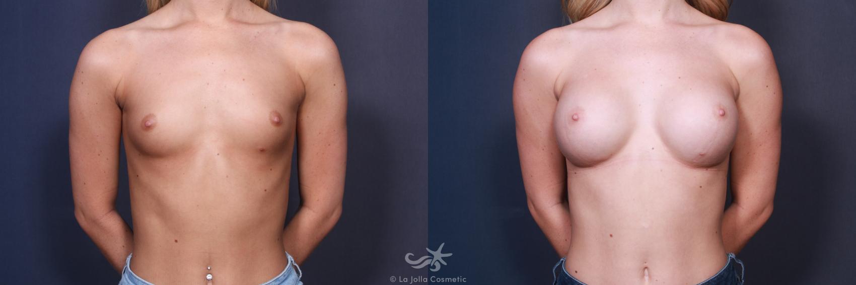 Before & After Breast Augmentation Result 225 Front View in San Diego, CA