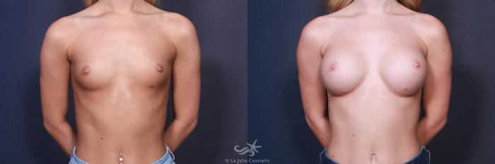 Before & After Breast Augmentation Result 225 Front View in San Diego, Carlsbad, CA