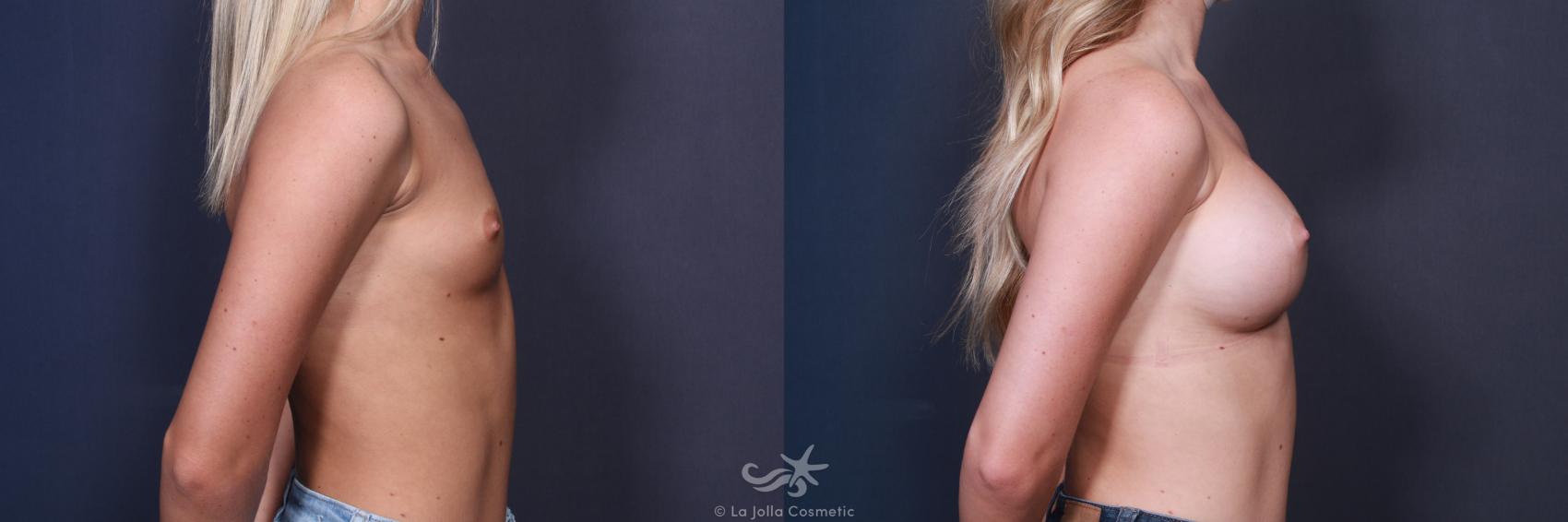 Before & After Breast Augmentation Result 225 Right Side View in San Diego, CA