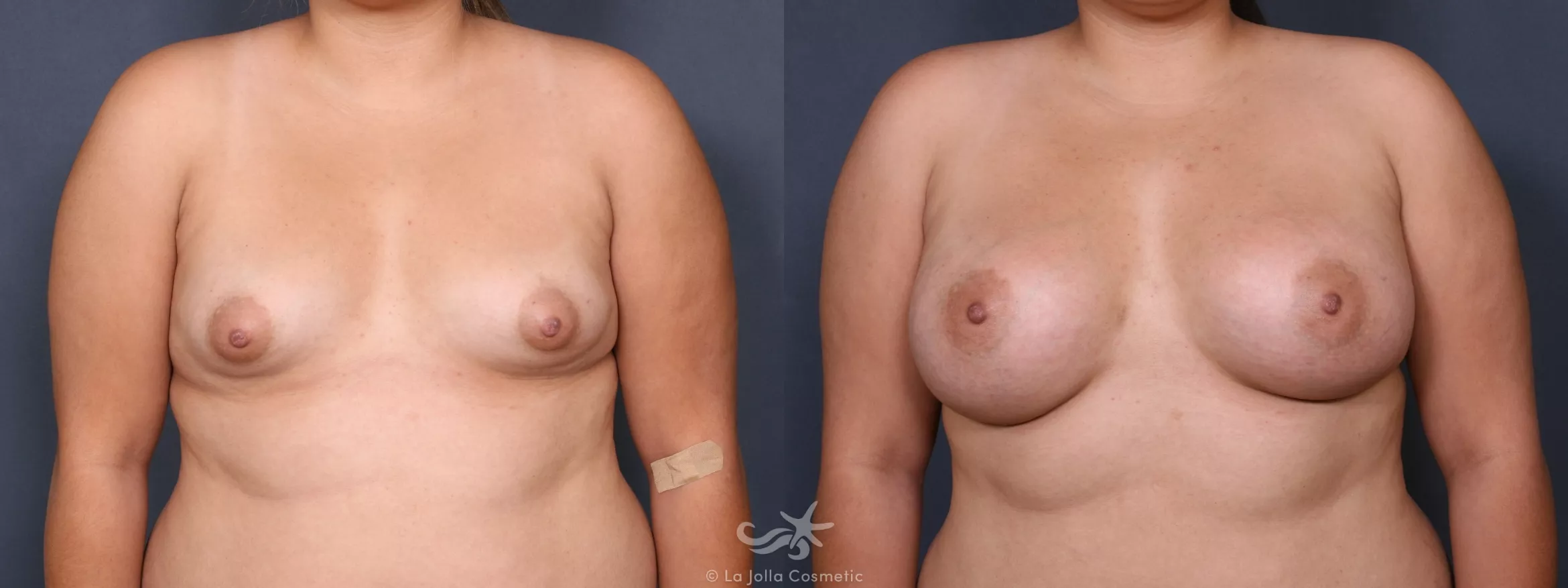 Before & After Breast Augmentation Result 226 Front View in San Diego, CA