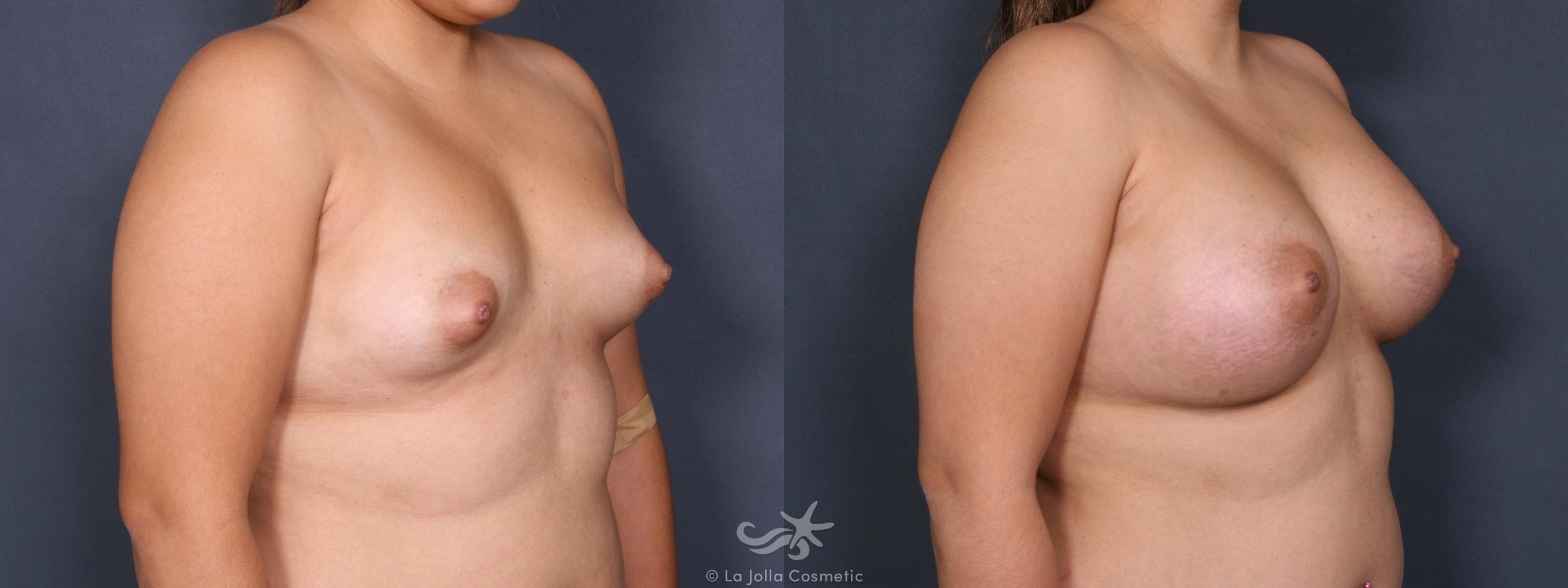 Before & After Breast Augmentation Result 226 Right Oblique View in San Diego, CA