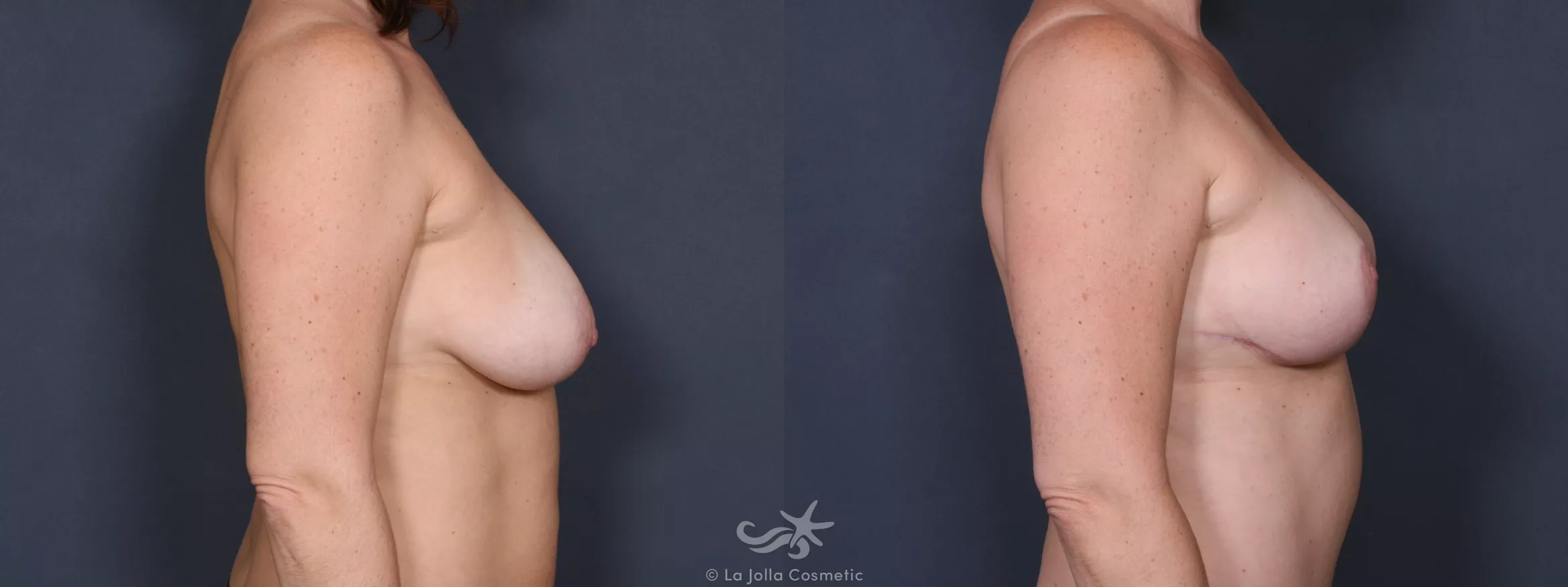 Before & After Breast Augmentation Result 227 Right Side View in San Diego, CA