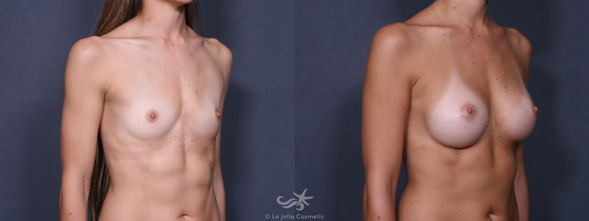 Before & After Breast Augmentation Result 230 Right Oblique View in San Diego, CA