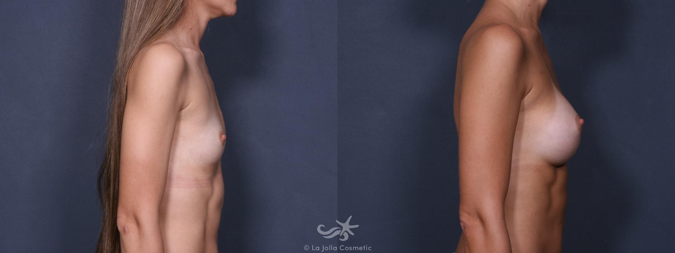 Before & After Breast Augmentation Result 230 Right Side View in San Diego, CA