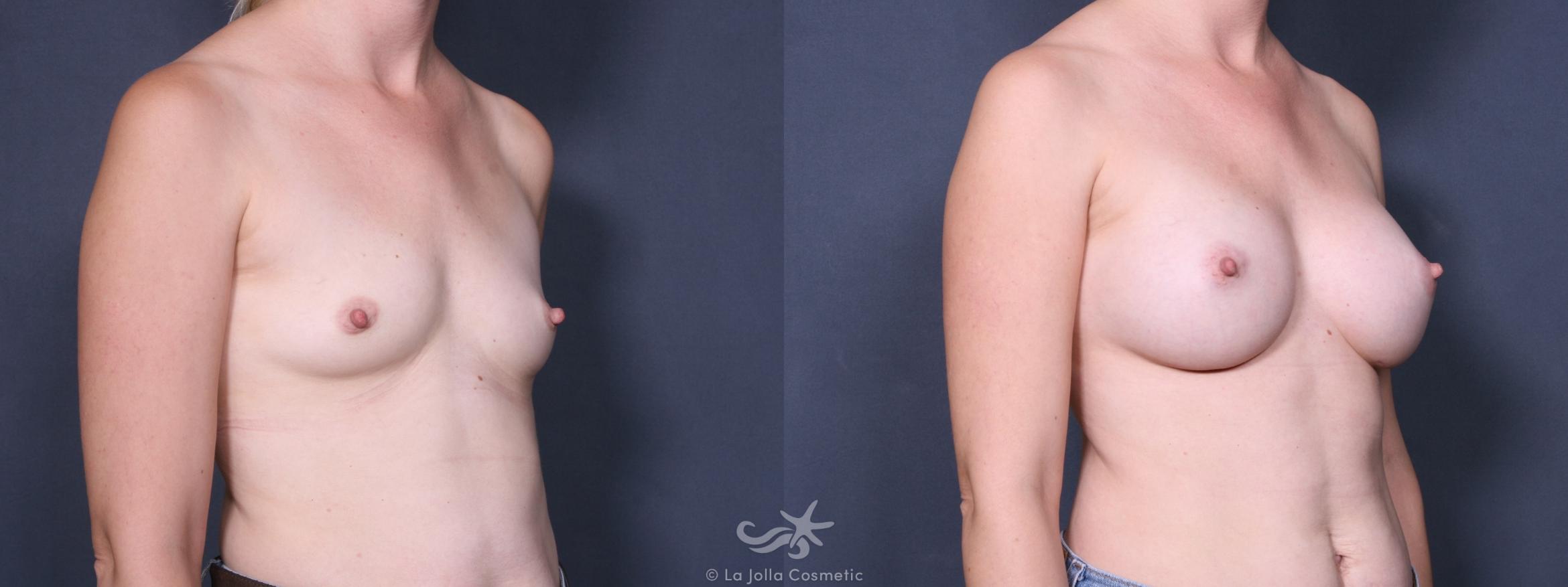 Before & After Breast Augmentation Result 231 Right Oblique View in San Diego, CA