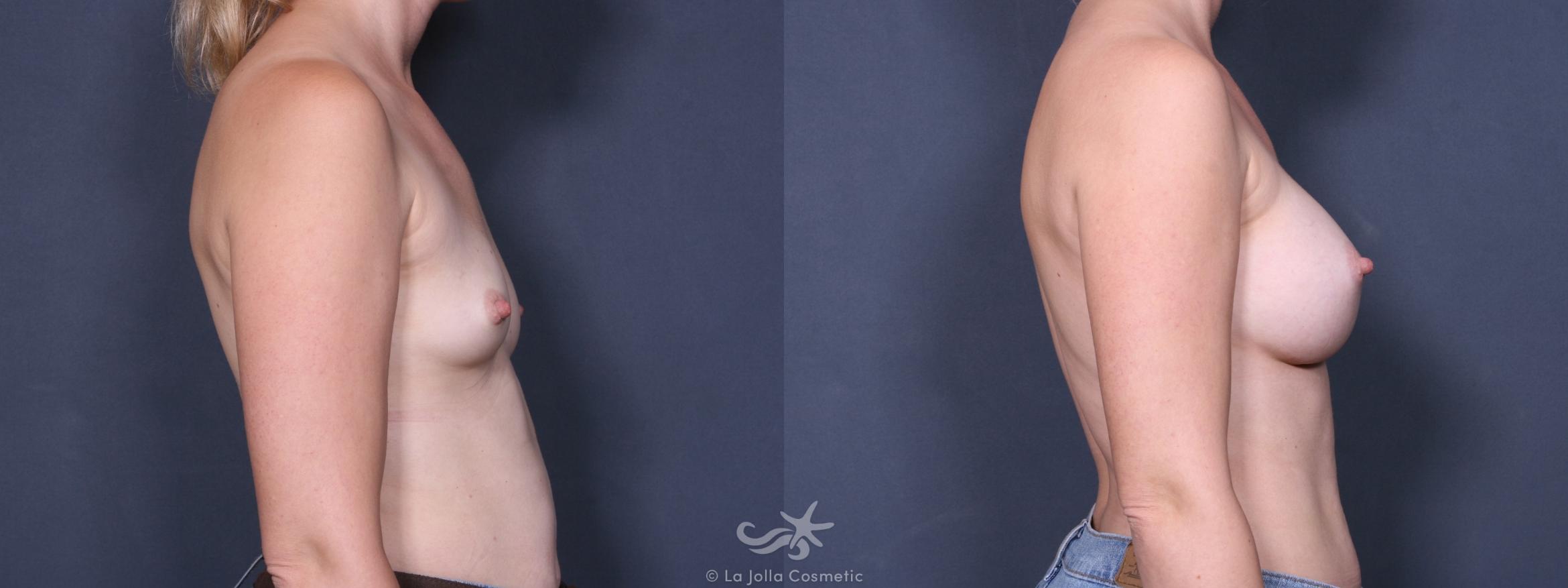 Before & After Breast Augmentation Result 231 Right Side View in San Diego, CA