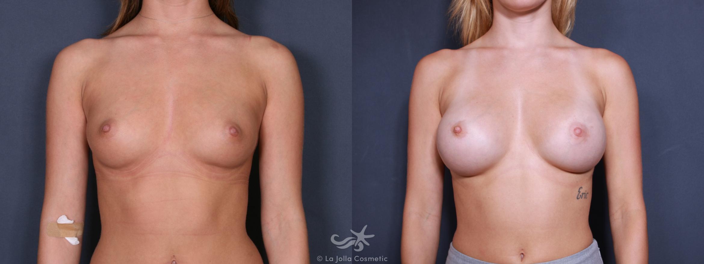 Before & After Breast Augmentation Result 233 Front View in San Diego, CA