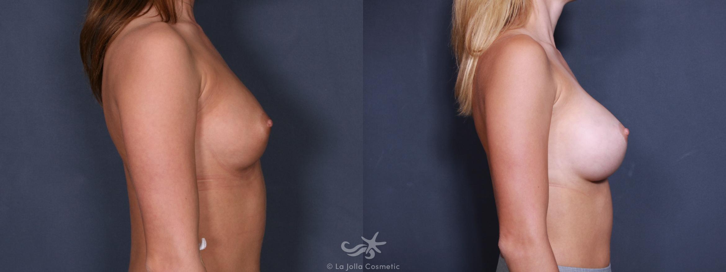 Before & After Breast Augmentation Result 233 Right Side View in San Diego, CA