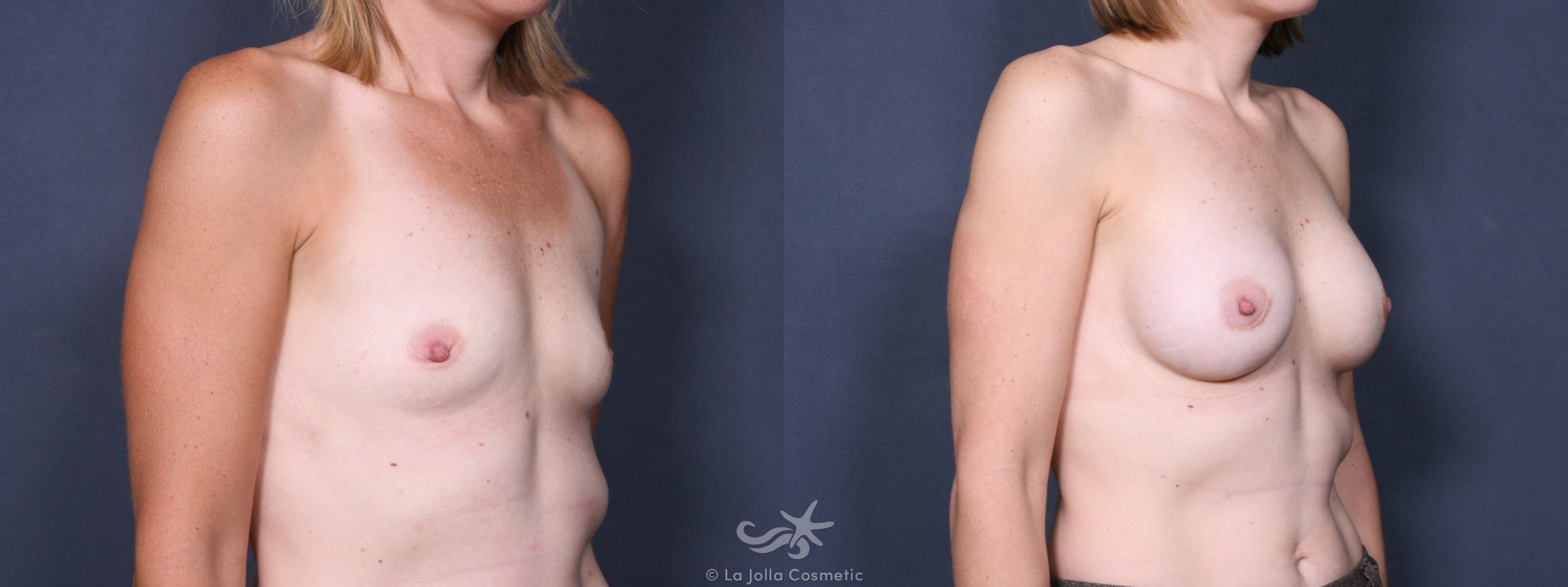 Before & After Breast Augmentation Result 235 Right Oblique View in San Diego, CA