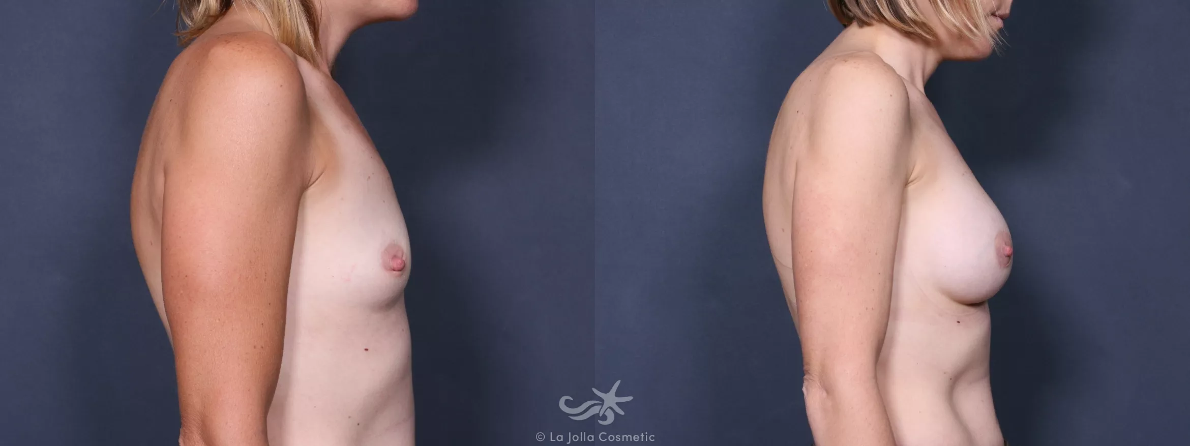 Before & After Breast Augmentation Result 235 Right Side View in San Diego, CA