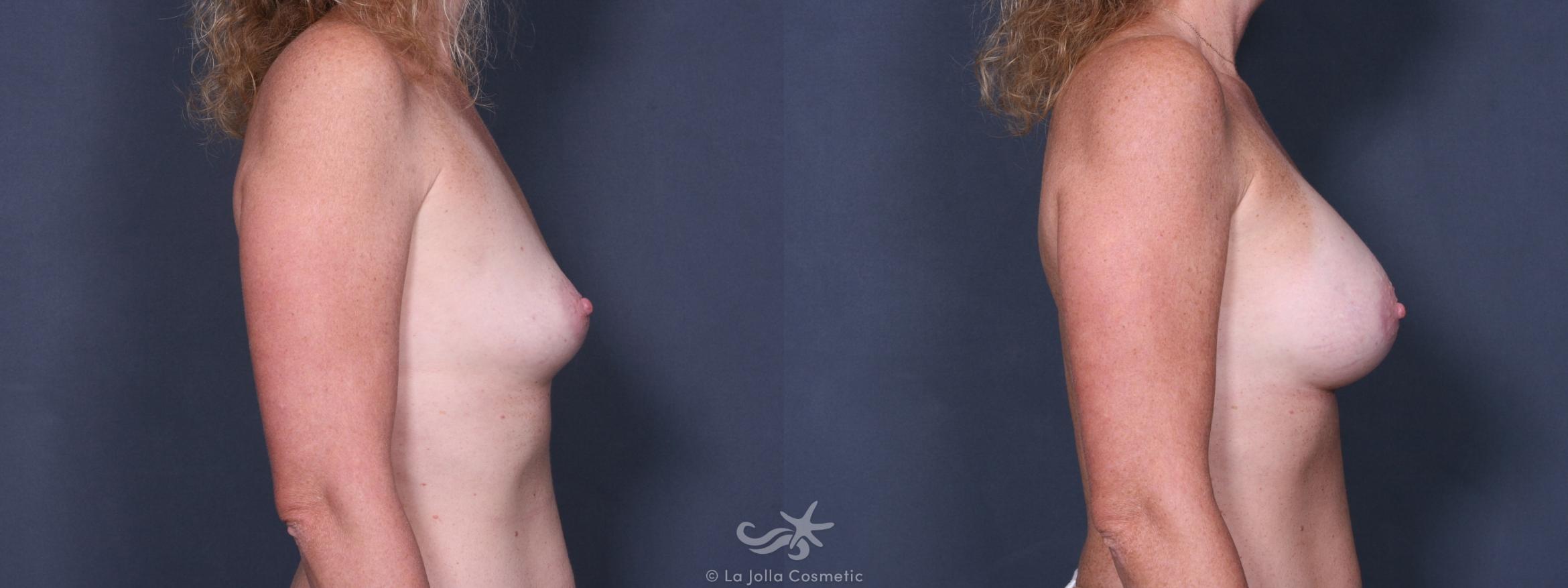 Before & After Breast Augmentation Result 236 Right Side View in San Diego, CA