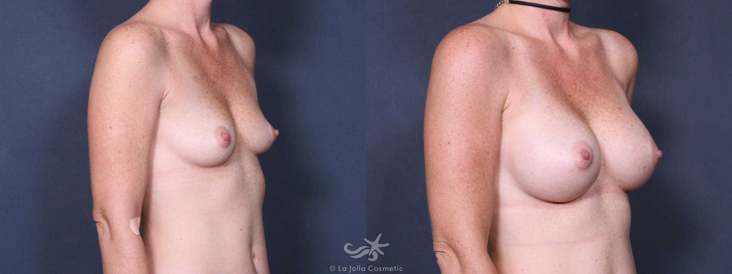 Before & After Breast Augmentation Result 239 Right Oblique View in San Diego, CA