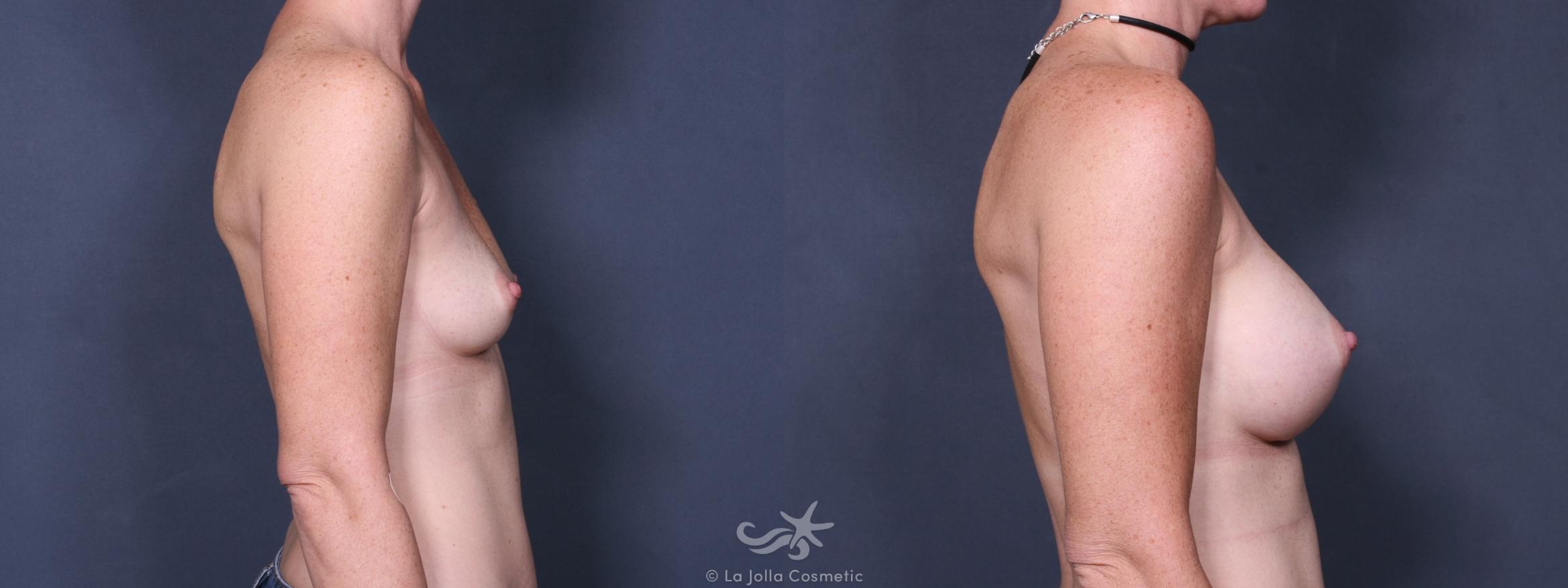 Before & After Breast Augmentation Result 239 Right Side View in San Diego, CA