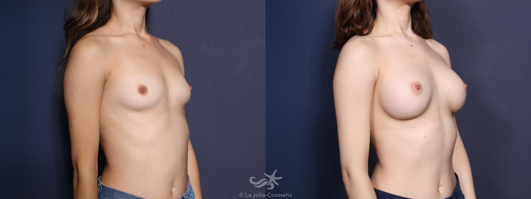 Before & After Breast Augmentation Result 24 Right Oblique View in San Diego, CA
