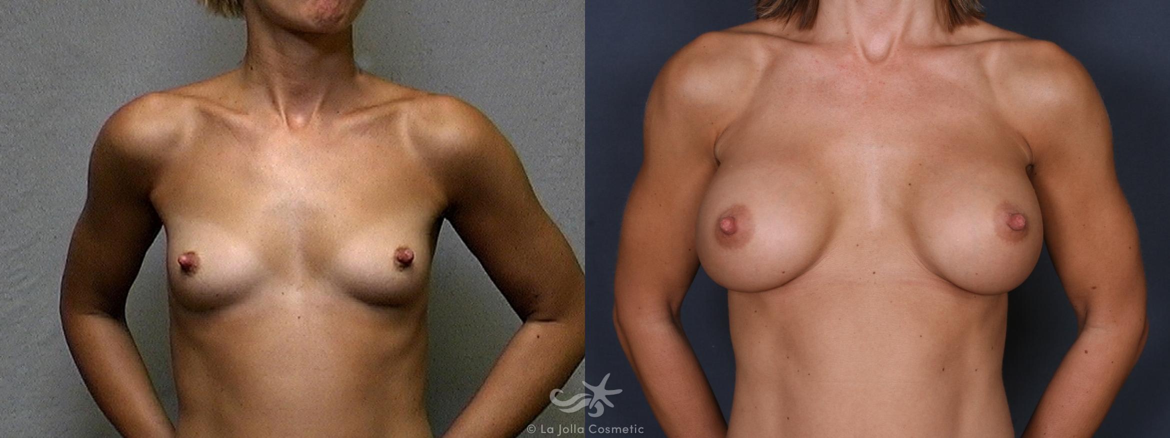 Before & After Breast Augmentation Result 240 Front View in San Diego, CA