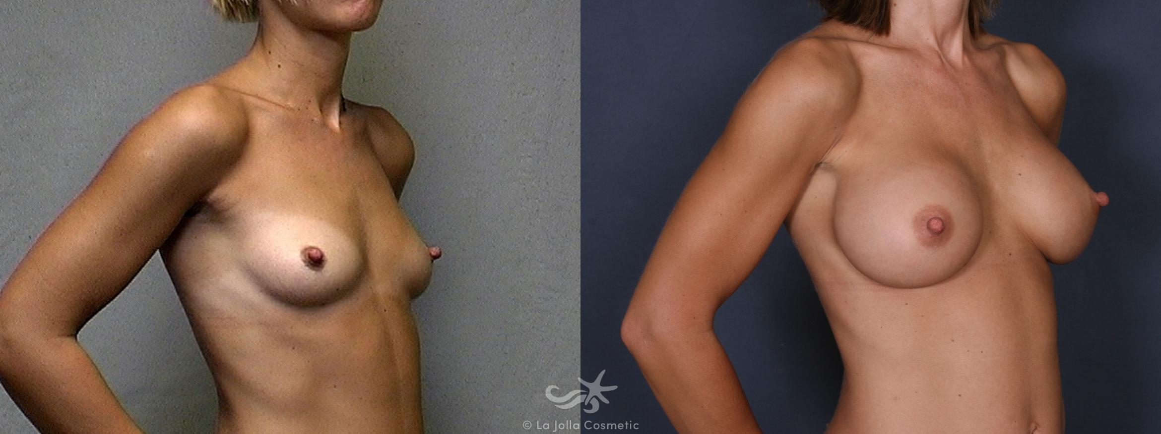 Before & After Breast Augmentation Result 240 Right Oblique View in San Diego, CA
