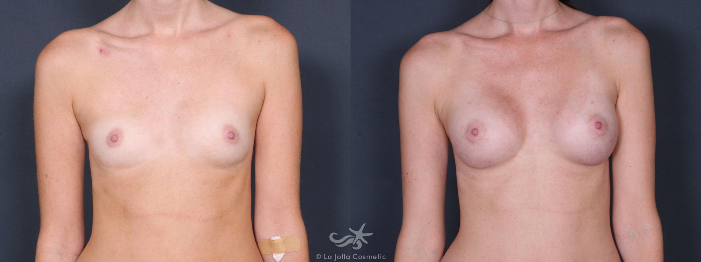Before & After Breast Augmentation Result 241 Front View in San Diego, CA